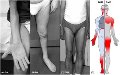 Core Clinical Phenotypes in Myotonic Dystrophies